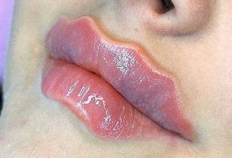 Älytön villitys: Huulet muotoillaan muistuttamaan paholaisen huulia! – Katso kuvat huultentäyttötrendistä!