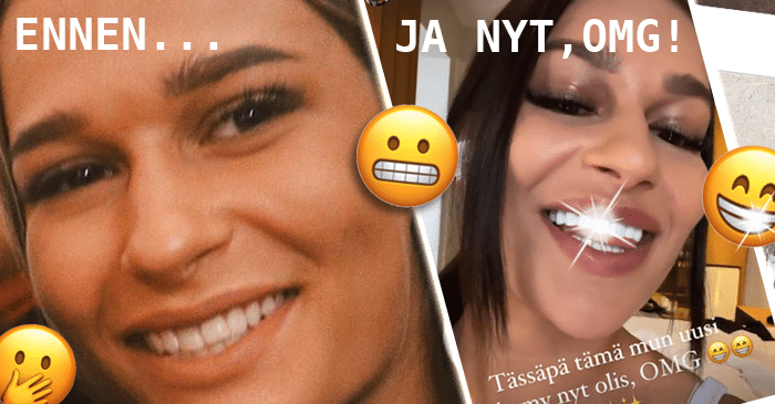 ”OMG! Tässä mun uusi hymy nyt olis!” TIS-Mattu esitteli uudet ulkomailla laitetut tekohampaat! – Kuvat!