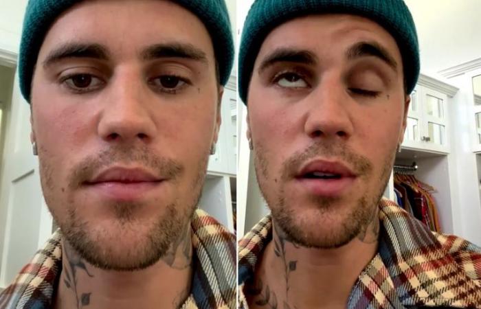 Justin Bieberin kasvot halvaantuivat – tältä laulaja näyttää nyt (Video)