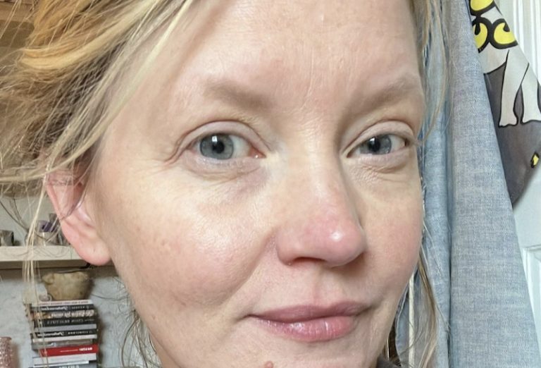 Ex-malli Pipsa Hurmerinta myöntää käyneensä pistoshoidoissa: ”Tilalle on tullut roikkuvaa ihoa”